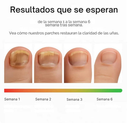 SMART-NAILS®- Parches Restauradores de uñas